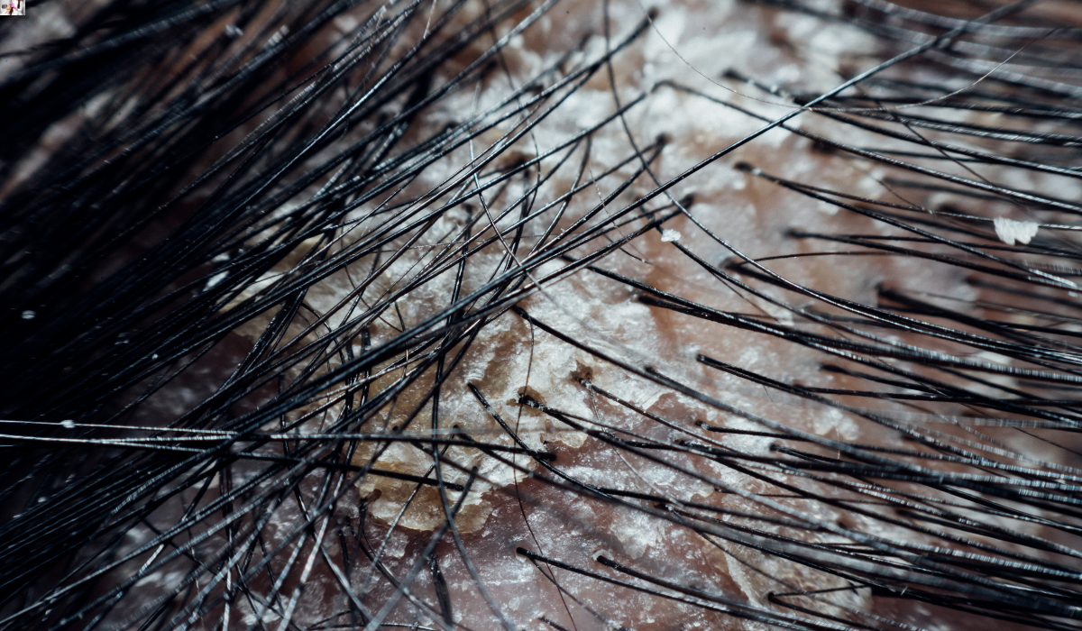 Hair Loss and Dandruff